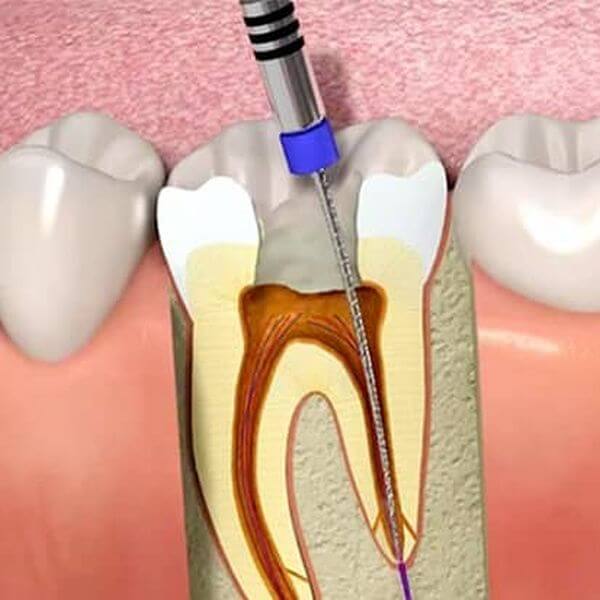 endodontie bacau